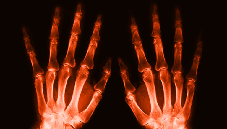 xray-image_hands